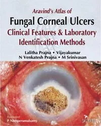 Buy Aravind's Atlas of Fungal Corneal Ulcers: Clinical Features & Lab Identification Methods by Lalitha Prajna, Jaypee Brothers, English, Hardcover, First Edition — BookShops.in