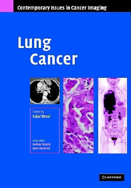 Lung Cancer (English, Sujal R. Desai)